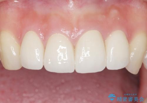 前歯をきれいにしたい 20代女性の治療後