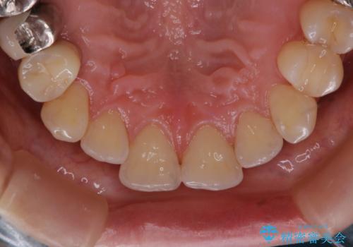 PMTCで定期的なメンテナンスをの治療後