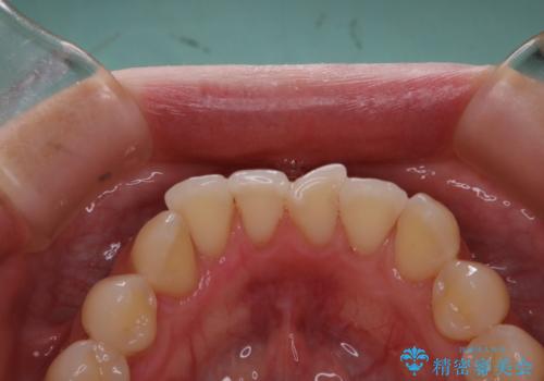 PMTCで定期的なメンテナンスをの治療後