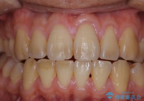 数年ぶりに歯のクリーニングの治療前