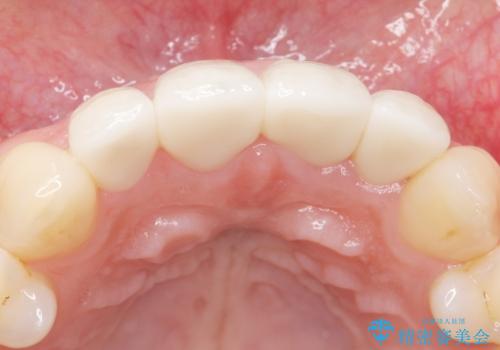 前歯をきれいにしたい 20代女性の治療後