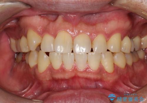 半年ぶりのメンテナンス　PMTCでピカピカな歯にの症例 治療後