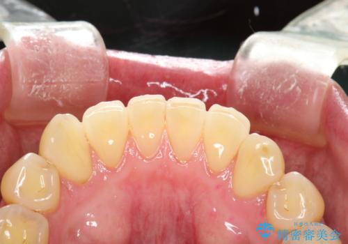 半年ぶりのメンテナンス PMTCでピカピカな歯にの治療後