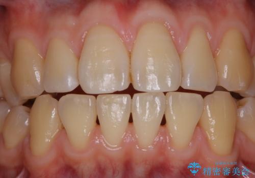 数年ぶりに歯のクリーニングの治療後