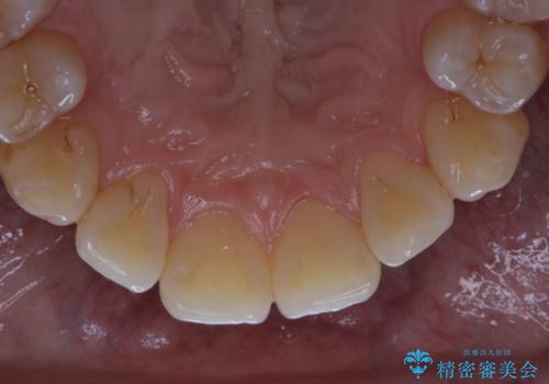 数年ぶりに歯のクリーニングの治療後