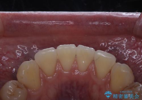 数年ぶりに歯のクリーニングの治療後