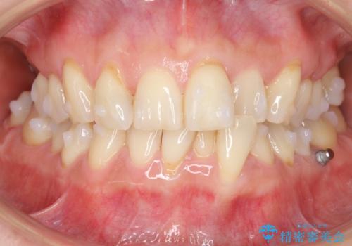 前歯が反対になっている マウスピース矯正+奥歯ブリッジの治療中