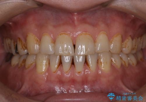 タバコとコーヒーによる頑固な着色落としの治療前