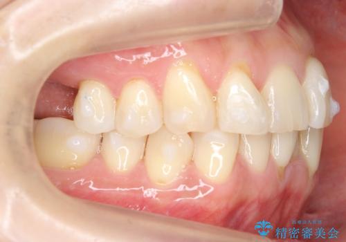 前歯が反対になっている マウスピース矯正+奥歯ブリッジの治療中