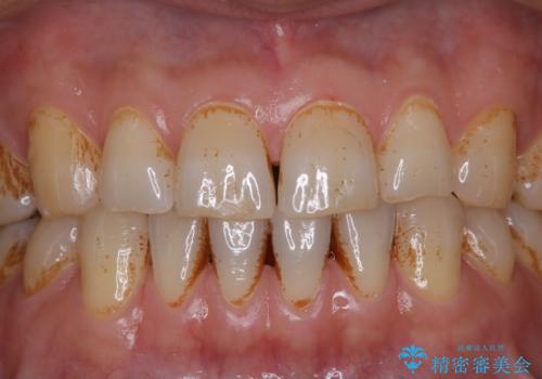 タバコとコーヒーによる頑固な着色落としの治療前
