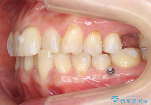 前歯が反対になっている　マウスピース矯正+奥歯ブリッジの治療中