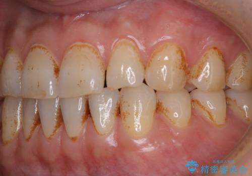 タバコとコーヒーによる頑固な着色落としの治療前