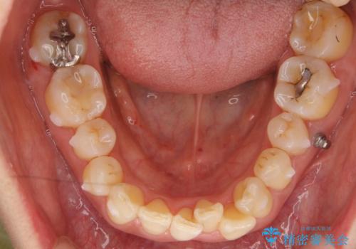 前歯が反対になっている マウスピース矯正+奥歯ブリッジの治療中