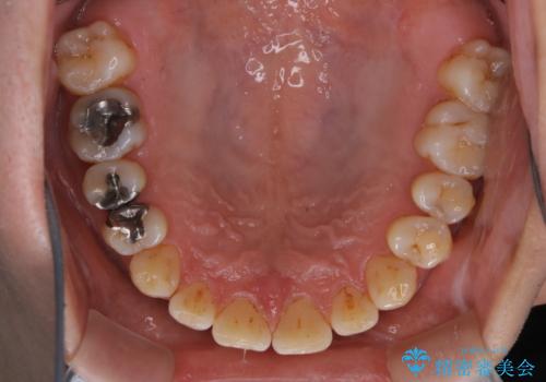 タバコとコーヒーによる頑固な着色落としの治療前