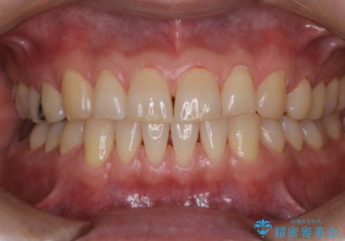 タバコとコーヒーによる頑固な着色落としの治療後