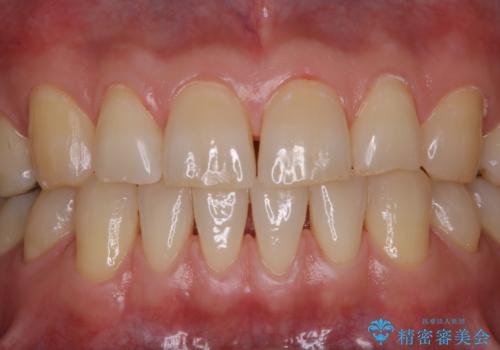 タバコとコーヒーによる頑固な着色落としの治療後
