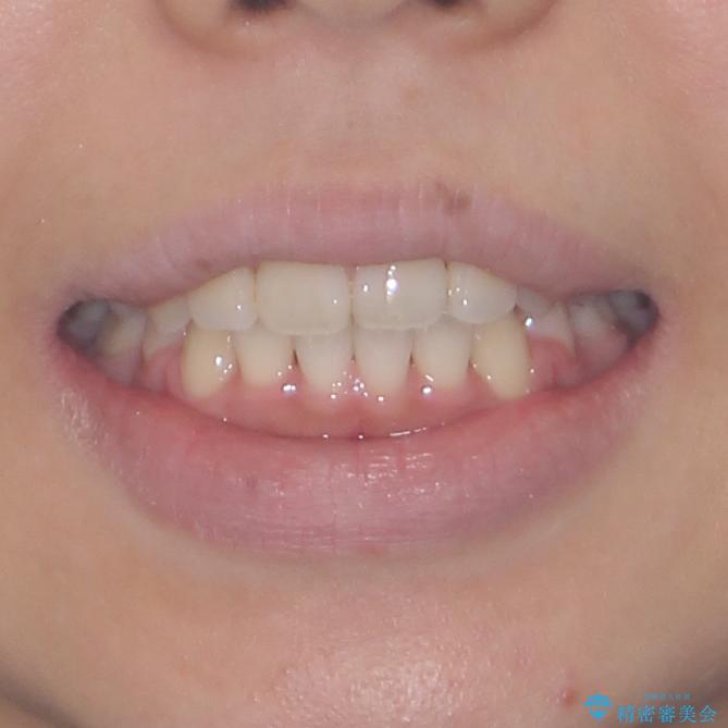 気になる八重歯を治したい 目立たないワイヤーでの抜歯矯正の治療後(顔貌)