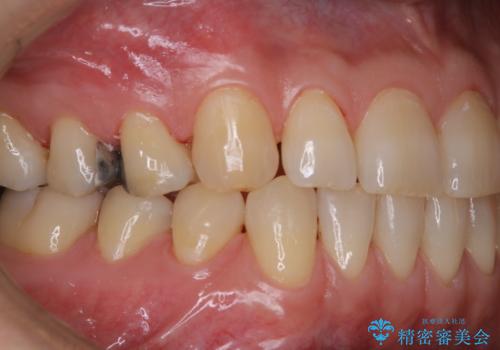タバコとコーヒーによる頑固な着色落としの治療後