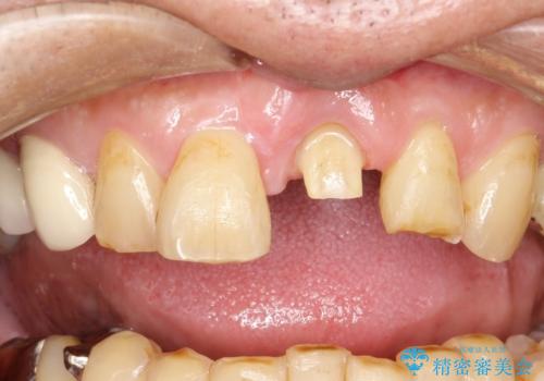 折れた前歯を使えるように、抜かないで残す方法の治療中