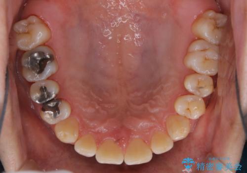 タバコとコーヒーによる頑固な着色落としの治療後