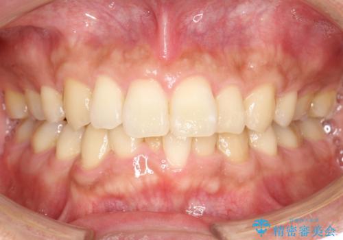 再矯正、後戻りを治したい、マウスピース矯正の治療前