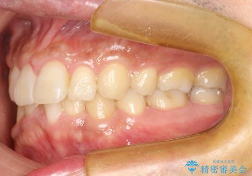 再矯正、後戻りを治したい、マウスピース矯正の治療前