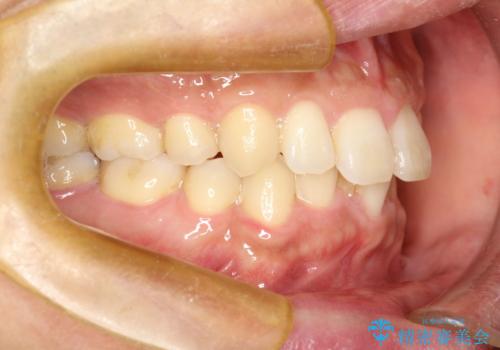 再矯正、後戻りを治したい、マウスピース矯正の治療前