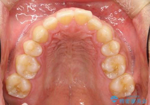 再矯正、後戻りを治したい、マウスピース矯正の治療前