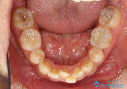 再矯正、後戻りを治したい、マウスピース矯正の治療前