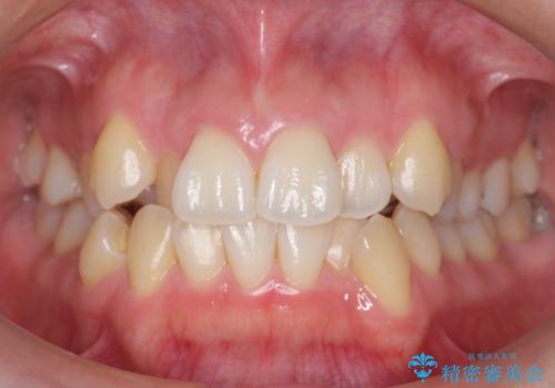 美容整形よりも、自然な美しさを。口元は大事です。の治療前