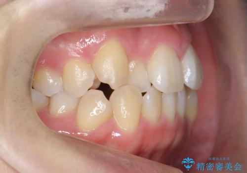 美容整形よりも、自然な美しさを。口元は大事です。の治療前