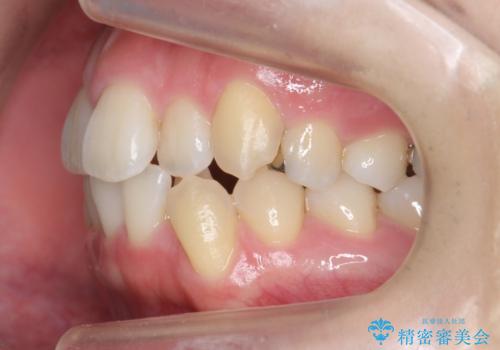 美容整形よりも、自然な美しさを。口元は大事です。の治療前