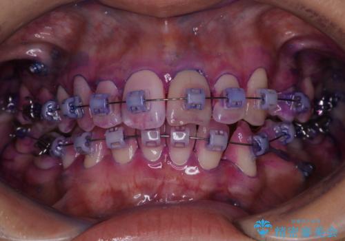 表のワイヤー矯正治療中にPMTCで綺麗にの治療前