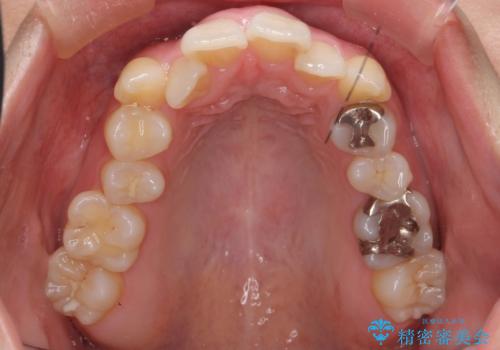 美容整形よりも、自然な美しさを。口元は大事です。の治療前