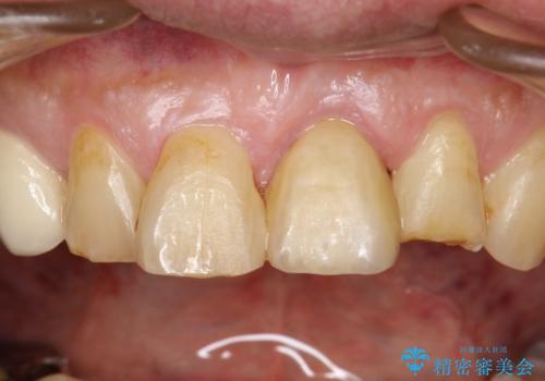 折れた前歯を使えるように、抜かないで残す方法の治療後