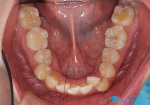 美容整形よりも、自然な美しさを。口元は大事です。の治療前
