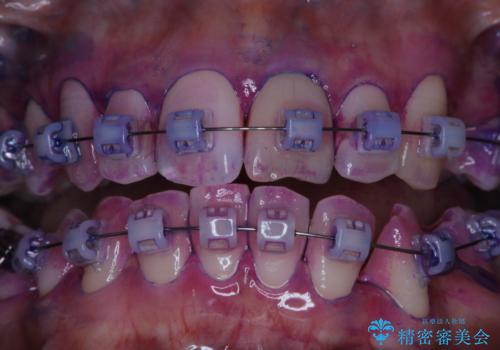 表のワイヤー矯正治療中にPMTCで綺麗にの治療前