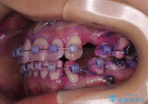 表のワイヤー矯正治療中にPMTCで綺麗にの治療前