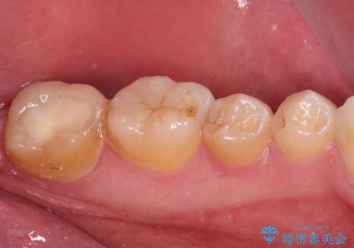 海外赴任前に気になる虫歯を治療したいの治療前