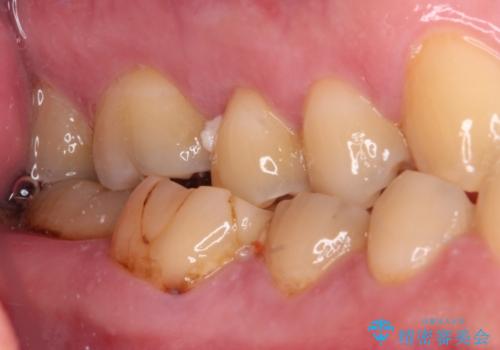 海外赴任前に気になる虫歯を治療したいの治療前