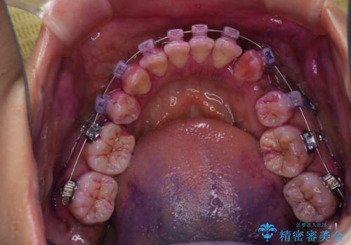 表のワイヤー矯正治療中にPMTCで綺麗にの治療前