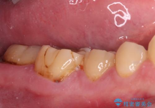 海外赴任前に気になる虫歯を治療したいの治療前