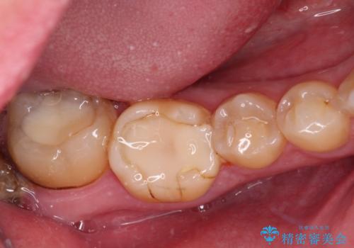 海外赴任前に気になる虫歯を治療したいの治療前