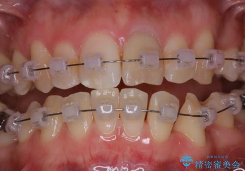 表のワイヤー矯正治療中にPMTCで綺麗にの治療後
