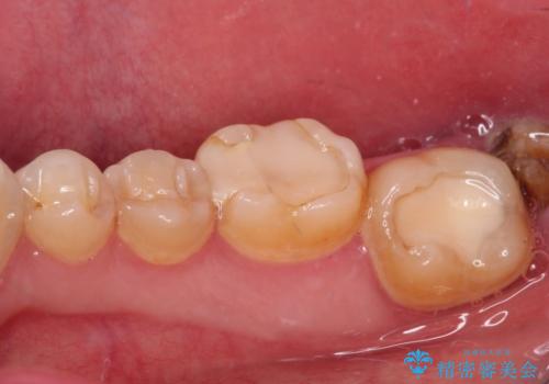 海外赴任前に気になる虫歯を治療したいの治療前