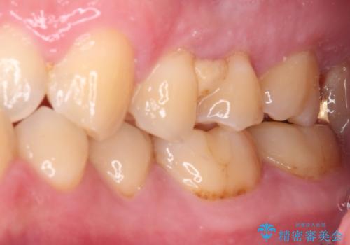 海外赴任前に気になる虫歯を治療したいの治療前