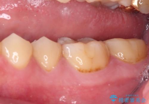 海外赴任前に気になる虫歯を治療したいの治療前