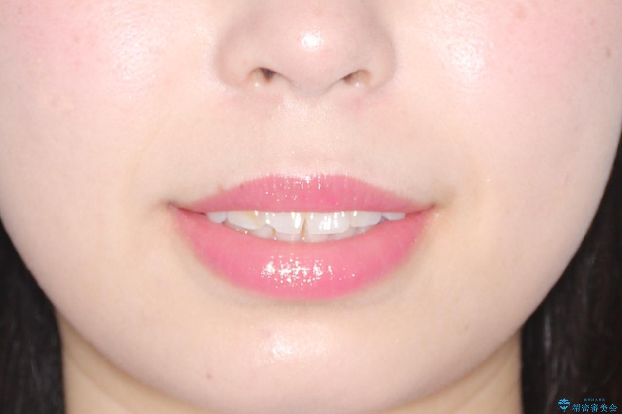 【インビザライン】前歯が出ているのを治したいの治療前(顔貌)