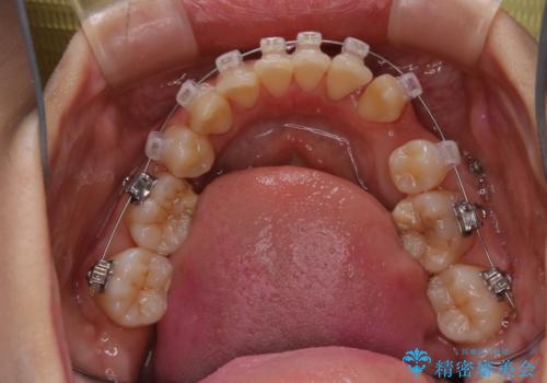 表のワイヤー矯正治療中にPMTCで綺麗にの治療後