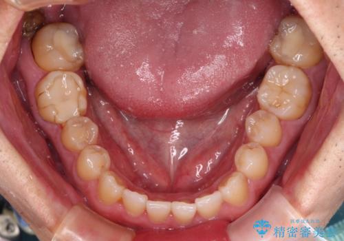 海外赴任前に気になる虫歯を治療したいの治療前